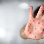 Measles Outbreak Persists In Mumbai, 717 Cases Identified In Maharashtra