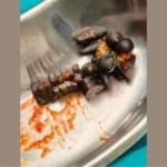 10-Year-Old Boy Saved After Swallowing Over 1 kg of Magnets; Emergency Surgery at Mira Road Hospital